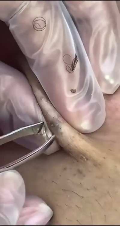 Ingrown