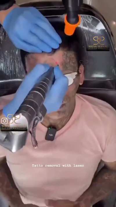 Facial Laser Tattoo Removal 