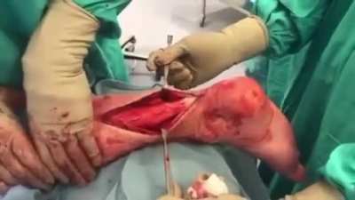 Assessing the Achilles’ tendon: the calf squeeze or Thompson test provides an accurate means for detecting complete Achilles tendon rupture