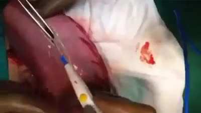 GIANT Hairball removed from woman&rsquo;s stomach! This video shows the surgical removal of a trichobezoar (hairball) that formed from the ingestion of human hair.