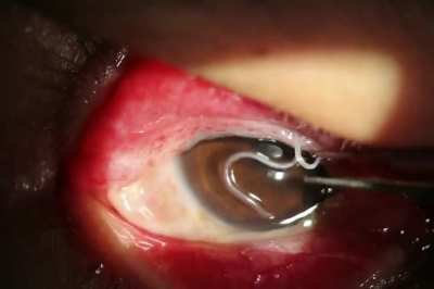 A 34-year-old man reported the sensation of a foreign body and itching in his right eye. Examination showed two worms beneath the upper eyelid.