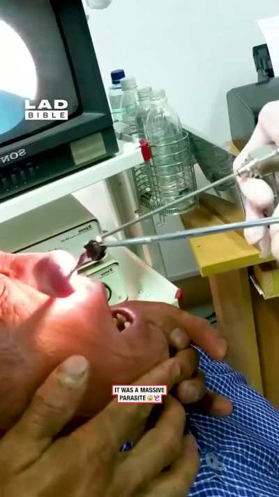 Nasal obstruction