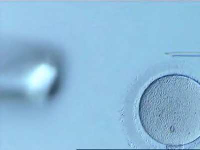 Creating a human: injecting single sperm directly into a woman&rsquo;s egg in-order to create a fertilized embryo. This is an advanced reproductive procedure, called Intracytoplasmic Sperm Injection (ICSI), done in an embryology lab during an IVF treatment.
