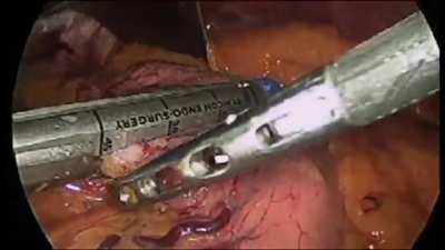 Gastric Bypass Surgery Demonstration