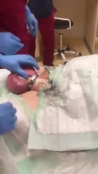 Cockring removal