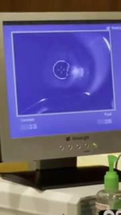 in case you’ve ever wondered how lasik works