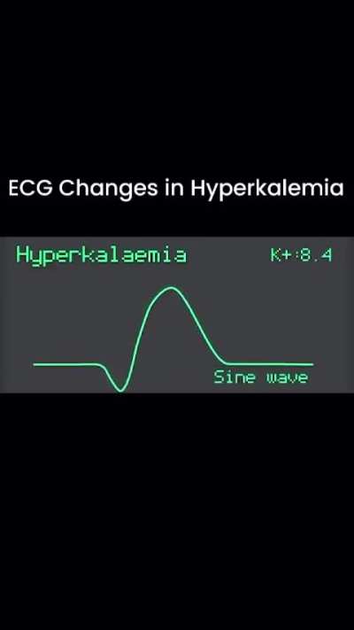 Since ECG interpretation is one of the topics that requires the deepest understanding of electricity, physics, and chemical principles, I wanted to share a video I came across on a medical page about the changes that appear on an ECG according to the leve