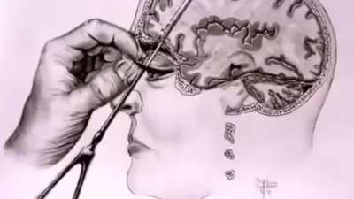 Lobotomy