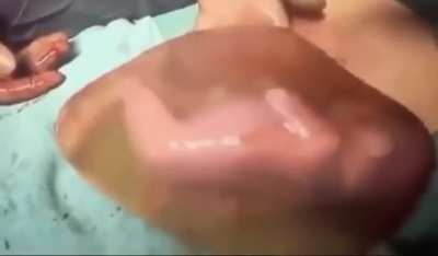 C-section baby born in amniotic sac