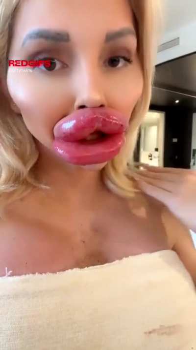 Think after my Last filling I have the perfect Lips (Vienna Xtreme)