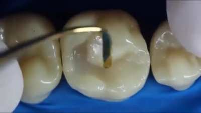 Filling In A Dental Filling Using &ldquo;Composite Fillings&rdquo;