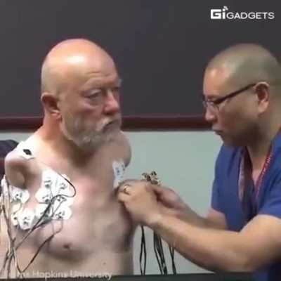 Awesome science helps amputee!