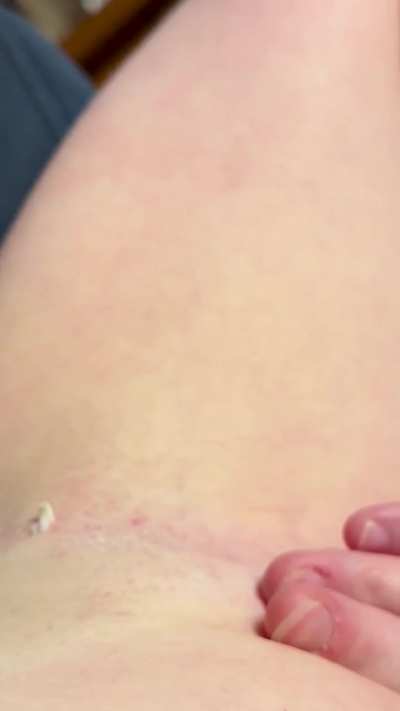Massive blackhead that was under my armpit for months