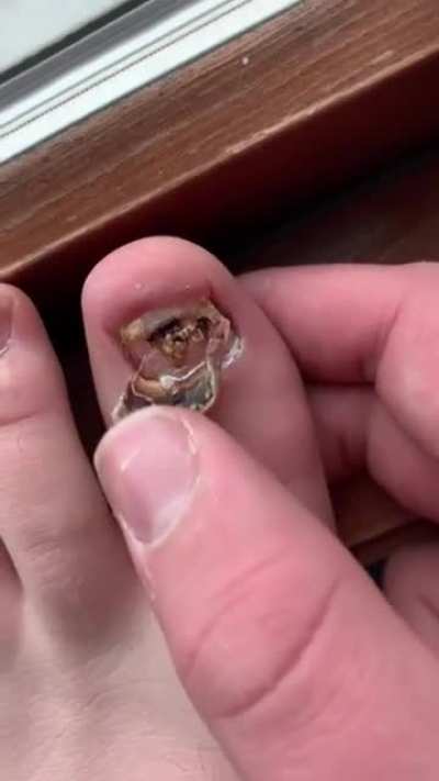 I&rsquo;ve been having issues with my toenail for a bit. This is the second time I&rsquo;ve had to do this...