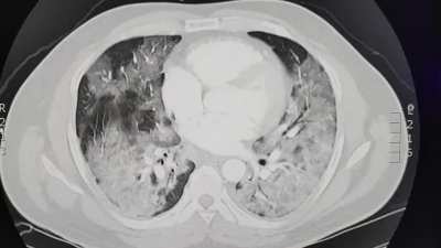 Their COVID test was "negative" but the CT said otherwise
