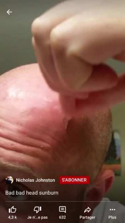 Thanks, I hate head sun burn