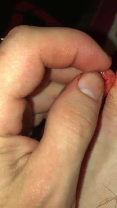 stubbed toe