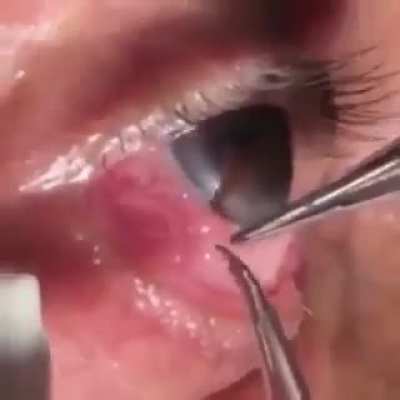 A live parasitic worm being removed from a man&rsquo;s eye