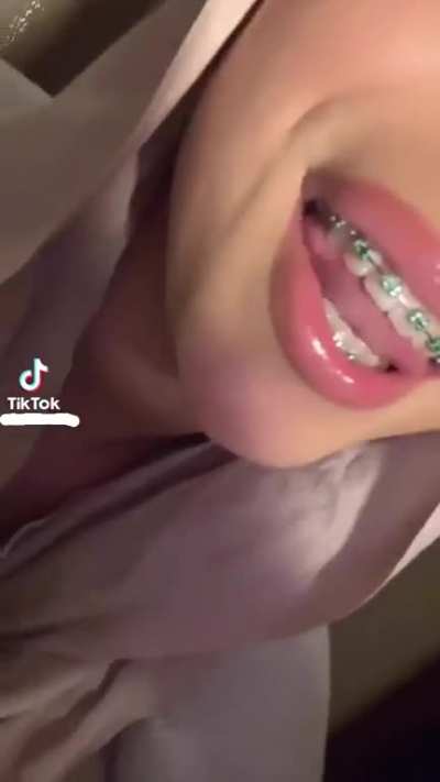 Braces😍