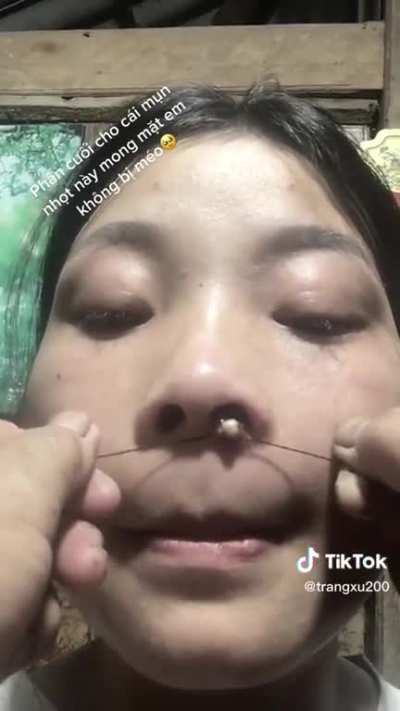 This looks sore as heck, but the way it pops out is kind of satisfying?