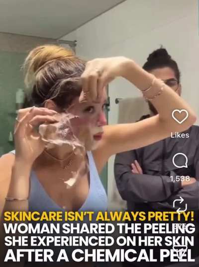 Chemical Face Peel 🫥