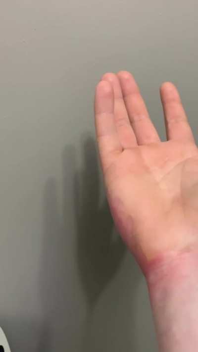 UPDATE: my friends had about a week and a half later no need for skin grafts or anything like that!! I appreciate everyone&rsquo;s concern!