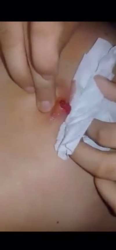 When you tryna be nice to your friend so you pop their benign cyst