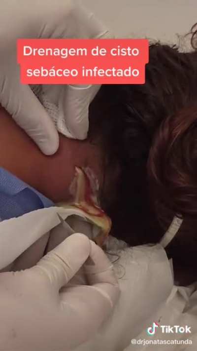 Neck Abscess I&amp;amp;D!