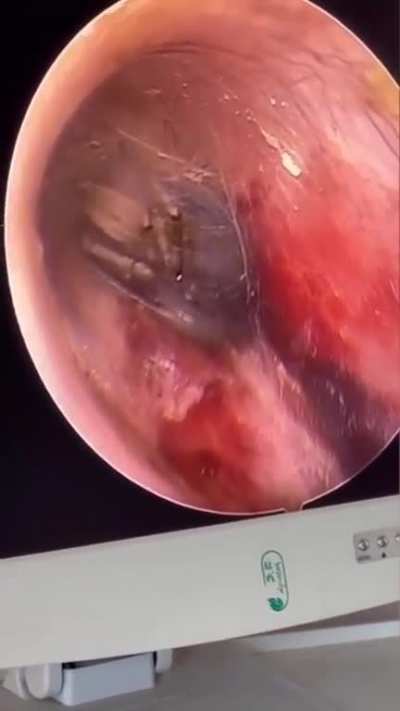 Spider crawls in a guy&rsquo;s ear while he slept
