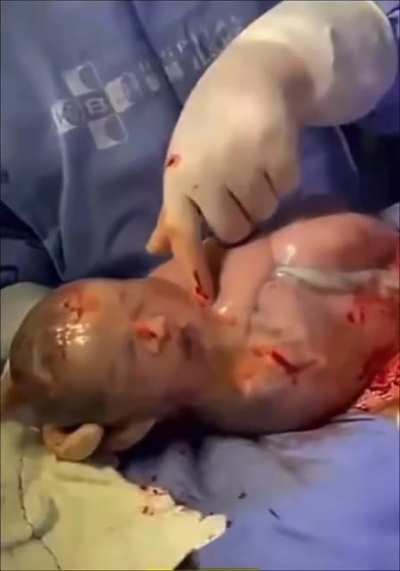 The moment when a newborn baby start breathing