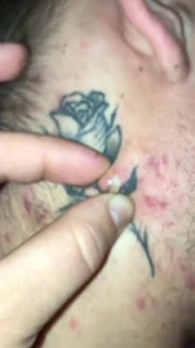 Pimple attack