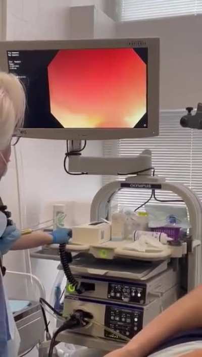 Cucumber removal from Anus