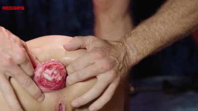 Anal Fisting Prolapse Link 👇