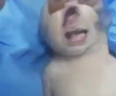 I'm going to hell for this (this baby has kleeblattsch&auml;del syndrome)