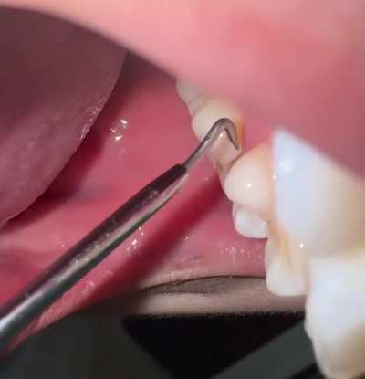 Stuff lodged in teeth