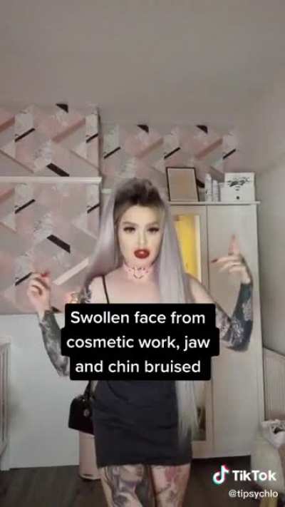 My guess is she&rsquo;s going to get that filler mustache dissolved. Hopefully I&rsquo;m right 🤞