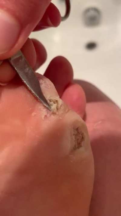 Debriding outer layer of wart skin- thought you guys might like to see this. Have been going at it with the ACV and duct tape for 1.5 weeks now and this is my fourth debriding session. Starting to feel like I&rsquo;m actually making progress!