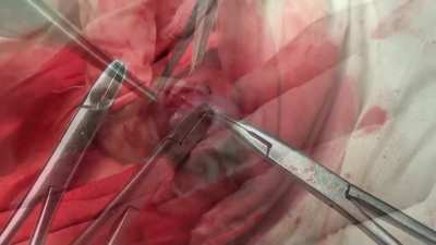 Properly Done Low &amp; Tight Circumcision 1 - If You Are Squeamish Watching Surgery Videos Please Don't Watch
