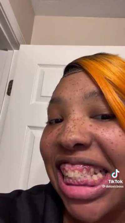 Taking braces off after 11 yrs. Her gums look so sore and swollen.