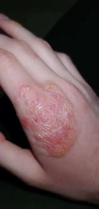 This rash flashing like Rudolph's nose with my pulse.