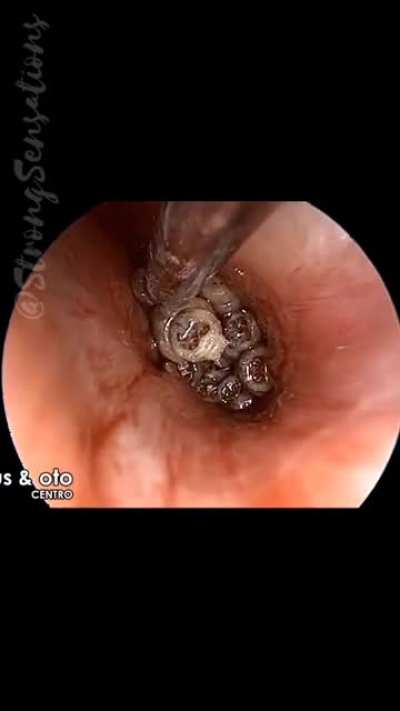 In the ears. I can&rsquo;t watch, but I know it belongs here.