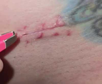 Partial stitch left over