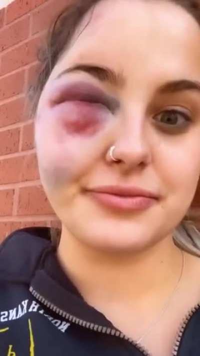 HMC after I smack a pole with my face.