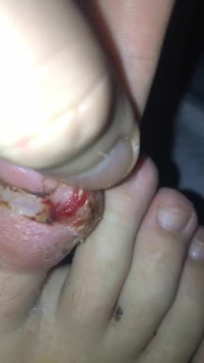 Ingrown toenail growing through skin.