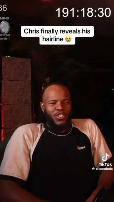 Is this worse than max&rsquo;s hairline?