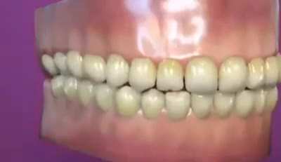 Thanks, i hate inflatable teeth