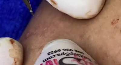 Blackheads part 2