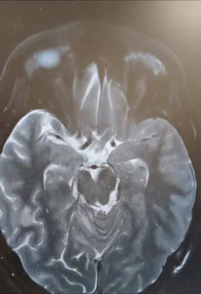 52yo male. Metastatic melanoma to brain. Discharged to hospice. 