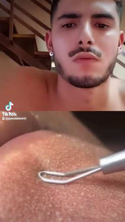 Pimple popping fans! Erm...