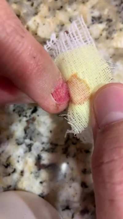 Here&rsquo;s a follow up to my fingernail removal. This hurt way worse and was like that for a good week! Original in comments!
